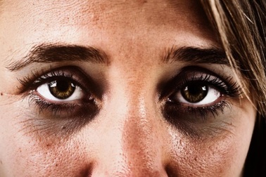 Quầng thâm dưới mắt: nguyên nhân và cách khắc phục