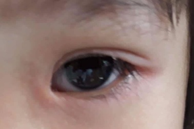 Rận ở “vùng kín” đi lạc lên mí mắt bệnh nhân