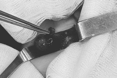 Bé trai 10 tháng tuổi bị xoắn tinh hoàn hoại tử