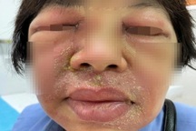 Sưng húp mắt, bỏng rộp, vằn vện khắp người sau một đêm vì kiến ba khoang