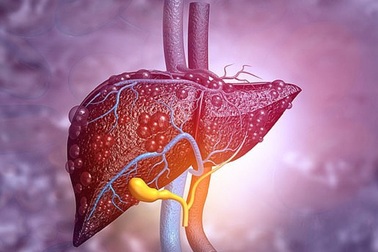 Xơ gan dễ biến chứng nguy hiểm tính mạng: Phòng ngừa thế nào?