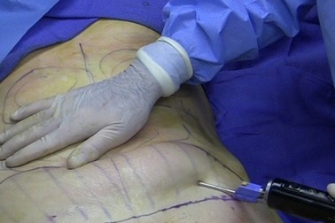 Người phụ nữ tử vong sau gần một tháng phẫu thuật thẩm mỹ