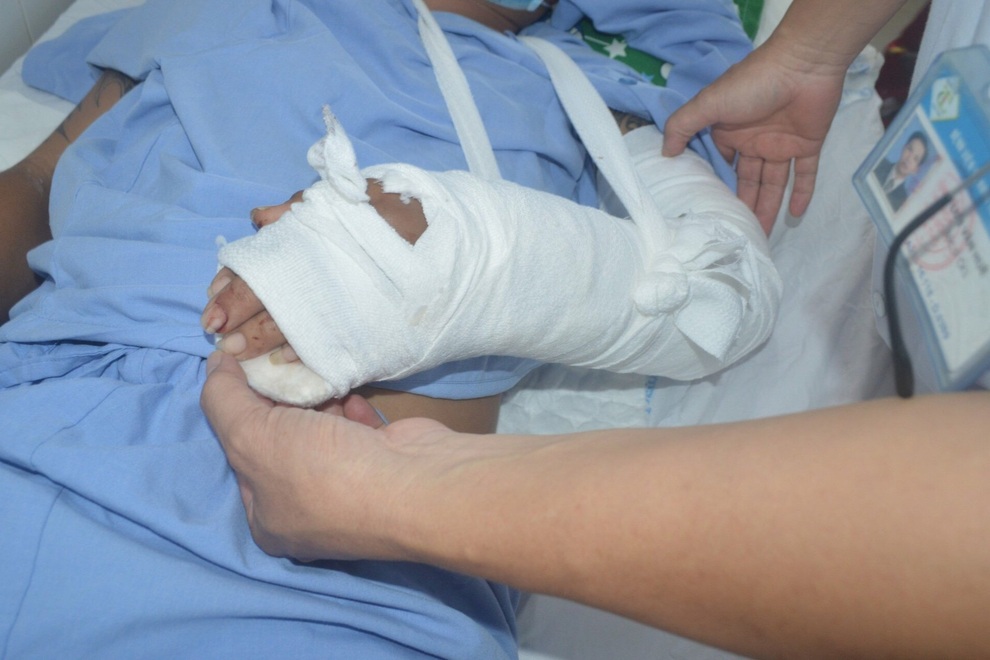Nối thành công bàn tay bị đứt lìa cho nam thanh niên 32 tuổi - 2 Nối thành công bàn tay bị đứt lìa cho nam thanh niên 32 tuổi - 2