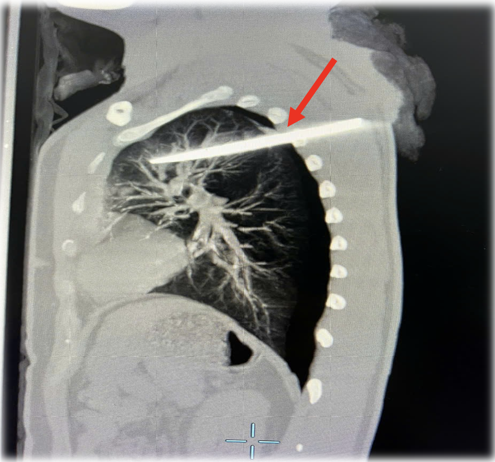 Cấp cứu nam thanh niên với vết thương thấu ngực, dị vật cắm sâu trong phổi - 1