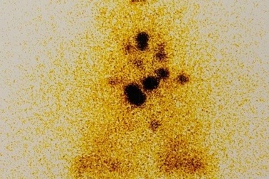 Lưu ý quan trọng khi điều trị ung thư tuyến giáp bằng Iod phóng xạ