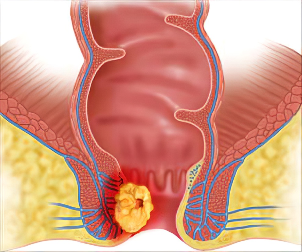 Nguyên nhân dẫn đến ung thư hậu môn - 1 Nguyên nhân dẫn đến ung thư hậu môn - 1