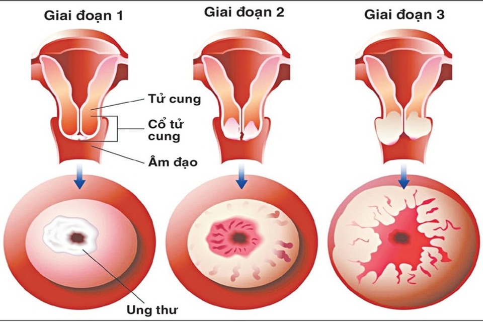 Dấu hiệu cảnh báo ung thư cổ tử cung - 1 Dấu hiệu cảnh báo ung thư cổ tử cung - 1