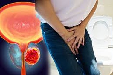 Các phương pháp điều trị ung thư tuyến tiền liệt