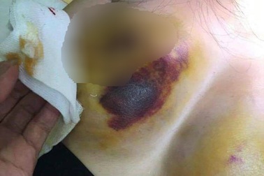 Ngực biến chứng, nhiều điểm tụ máu sau nâng ngực tại bệnh viện thẩm mỹ?