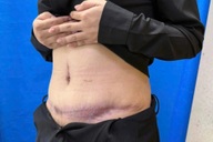 Bụng thiếu nữ biến dạng, hoại tử vì mũi tiêm trị sẹo sau khi hút mỡ