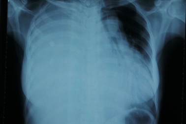 Chẻ xương ức, bóc khối u “hiếm” chiếm trọn lồng ngực