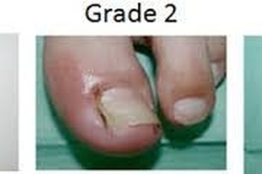 Bệnh nhân điều trị ung thư phổi cảnh giác với viêm quanh móng