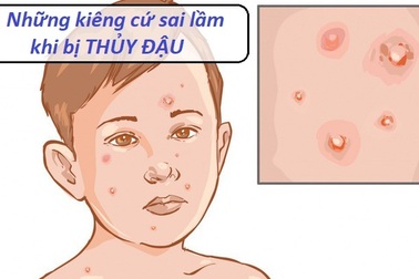 Bệnh thủy đậu và những sai lầm trong kiêng cữ