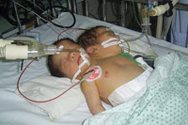 Dị thường ở cặp song thai là do sự phân chia phôi muộn