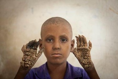 Cậu bé “người cây” ở Bangladesh