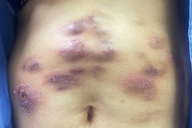 Thẩm mỹ viện tiêm tan mỡ làm nát bụng bà mẹ 2 con, đổ lỗi do "còn trinh"