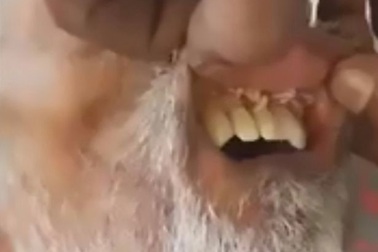 Giòi nhung nhúc trong miệng bệnh nhân đột quỵ