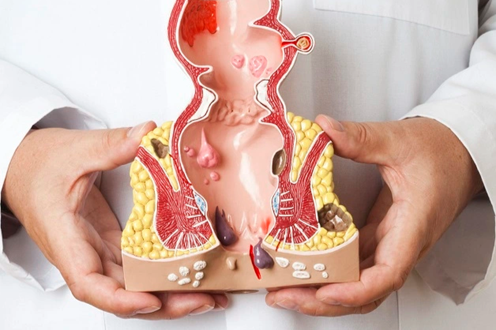 3 phương pháp giúp điều trị ung thư hậu môn - 1 3 phương pháp giúp điều trị ung thư hậu môn - 1