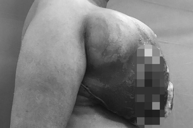 Bỏ dở điều trị ung thư vú, người phụ nữ mọc khối u mới to như quả bưởi