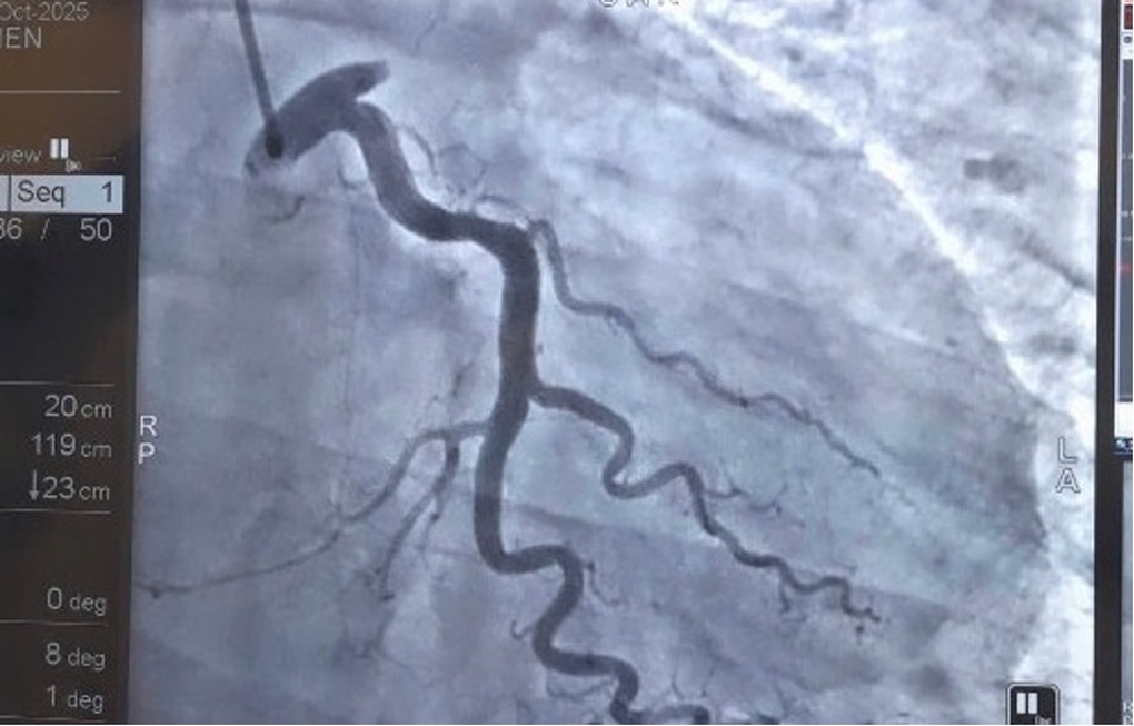 Cứu bệnh nhân người Trung Quốc nhồi máu cơ tim khi đang chơi cầu lông - 2 Cứu bệnh nhân người Trung Quốc nhồi máu cơ tim khi đang chơi cầu lông - 2