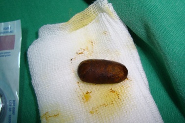 Cấp cứu thành công bệnh nhân bị tắc mật do sỏi ống mật chủ