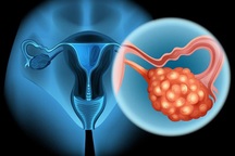 7 dấu hiệu âm thầm của ung thư buồng trứng thường bị bỏ qua