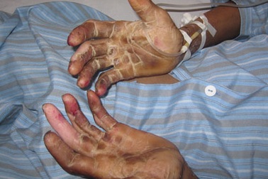 Có thể tái nhiễm bệnh liên cầu khuẩn lợn?