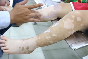 Bạch biến da, nỗi ám ảnh trên cơ thể người bệnh