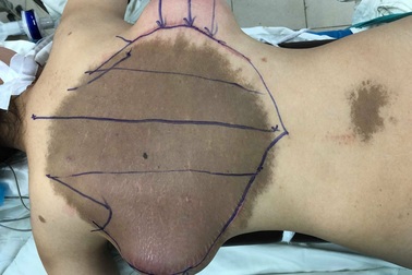 Mảng “da trâu” khổng lồ ở lưng được phẫu thuật điều trị thành công