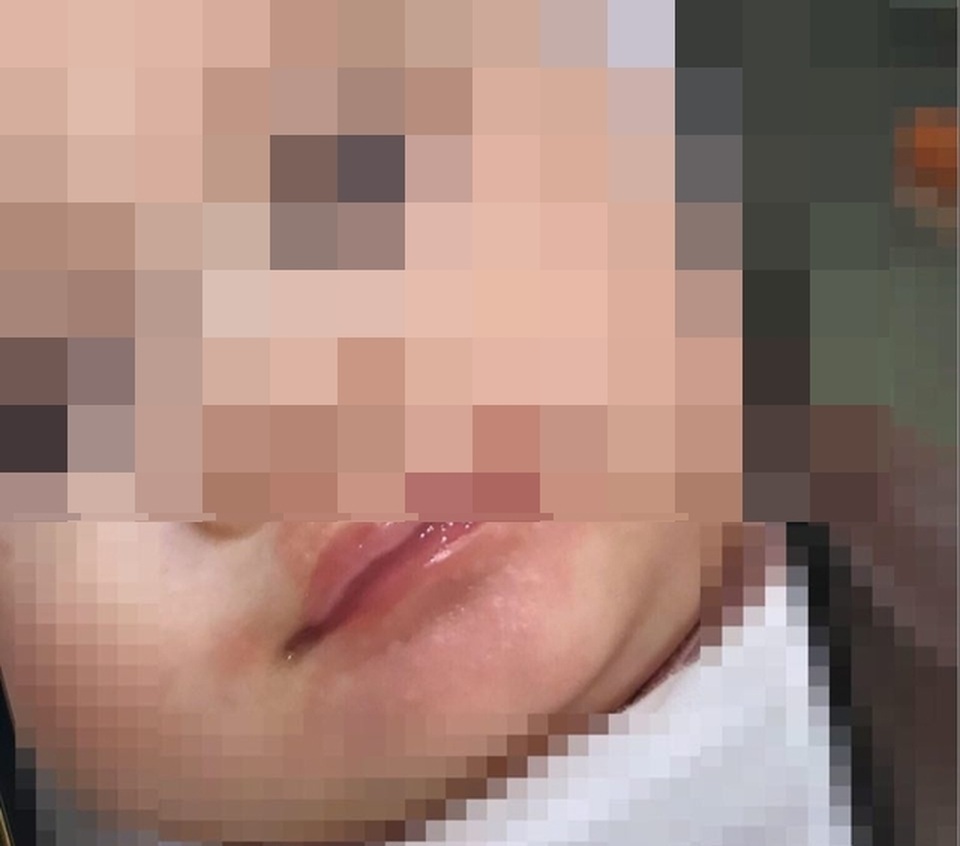 Uống sữa non trộn sữa mẹ, bé gái 3 tháng tuổi sốc nguy kịch - 1 Uống sữa non trộn sữa mẹ, bé gái 3 tháng tuổi sốc nguy kịch - 1