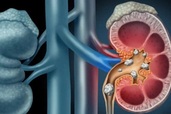 Sỏi thận âm thầm gây suy thận như thế nào?