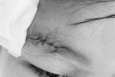 Bé trai 10 tuổi ở TPHCM bị bạn bắn đạn súng hơi găm vào xương sọ