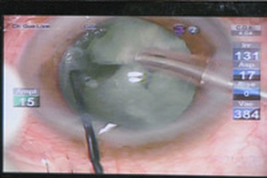 Bệnh viện Mắt TP.HCM thực hiện chuyển giao kỹ thuật hiện đại