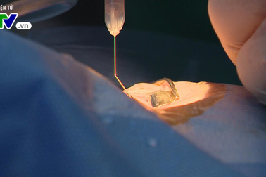 Vì sao giác mạc bé Hải An lại được ghép cho 2 người lớn?