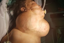 Phẫu thuật lấy khối u “khủng” cho nữ bệnh nhân nghèo