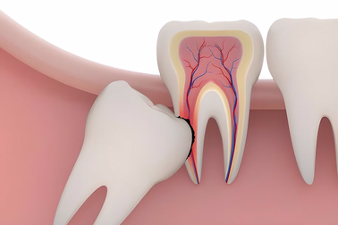 Nhổ răng khôn có được hưởng bảo hiểm y tế không?