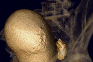 Lấy cục sỏi trứng ngỗng trong bàng quang bệnh nhân