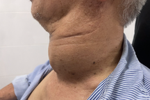 Khối u hai bên to như 2 quả bưởi khiến cụ ông khó ăn uống