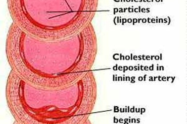 Cách nào giảm cholesterol (mỡ máu)?