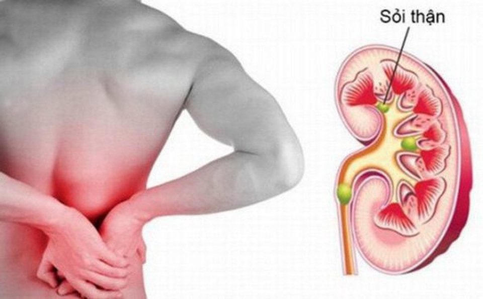 Cách điều trị sỏi thận hiệu quả và ít đau đớn - 1 Cách điều trị sỏi thận hiệu quả và ít đau đớn - 1