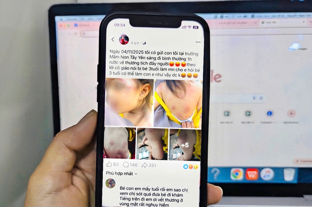 Bé gái 3 tuổi bị nhiều vết bầm tím, dấu răng trên người sau giờ học - 1 Bé gái 3 tuổi bị nhiều vết bầm tím, dấu răng trên người sau giờ học - 1