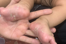 Bé trai 3 tháng tuổi đã mắc giang mai