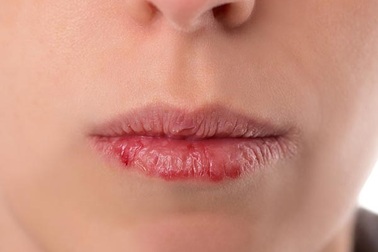 8 dấu hiệu cảnh báo sức khỏe từ đôi môi