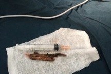 Chơi đùa ngã vào bụi cây, bé trai 9 tuổi bị nhánh cây đâm xuyên cổ