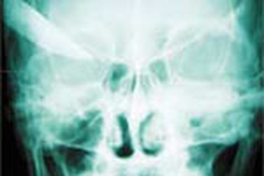 Cứu sống người bị đâm thủng não