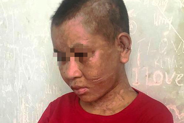 Một phụ nữ nghi bị chủ tra tấn man rợ đến "thân tàn ma dại"