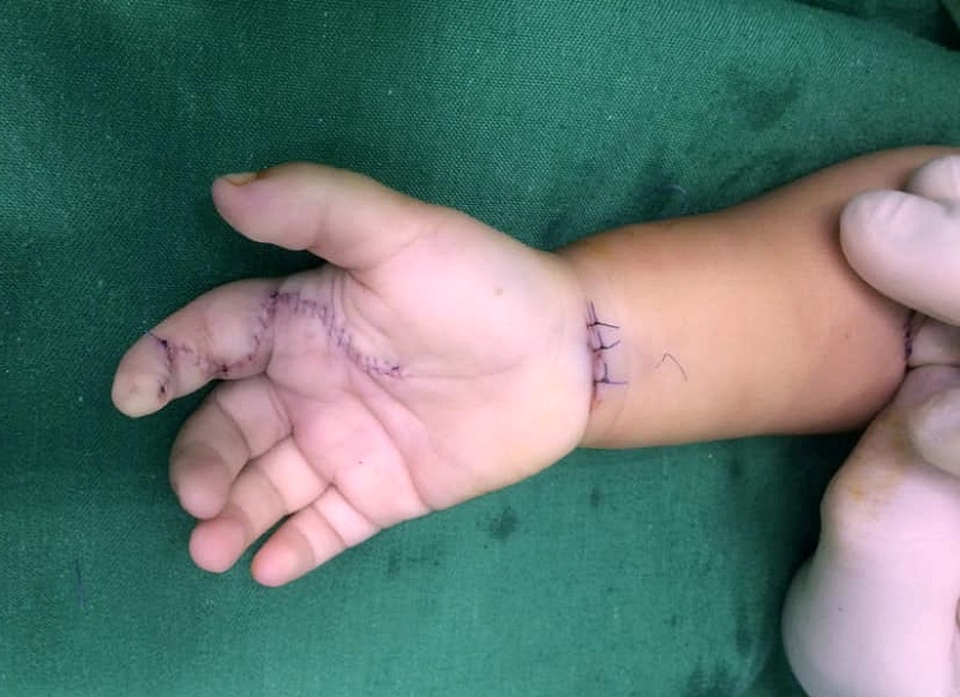 Cầm phải sâu róm, bé 1 tuổi bị viêm thành ổ mủ vì sai lầm của cha mẹ - 1 Cầm phải sâu róm, bé 1 tuổi bị viêm thành ổ mủ vì sai lầm của cha mẹ - 1
