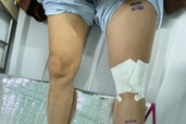 Người phụ nữ đột ngột phù một bên chân, chiến đấu với tử thần suốt 21 ngày