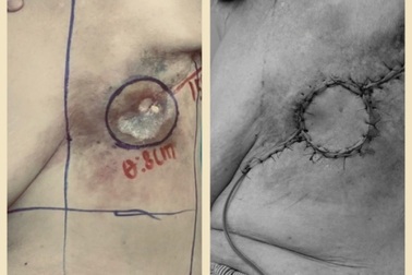 "Vá" lỗ hổng sâu vùng ngực do loét sau 20 năm điều trị ung thư vú