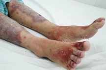 Cô gái bong tróc da toàn thân, nguy kịch sau khi uống thực phẩm chức năng